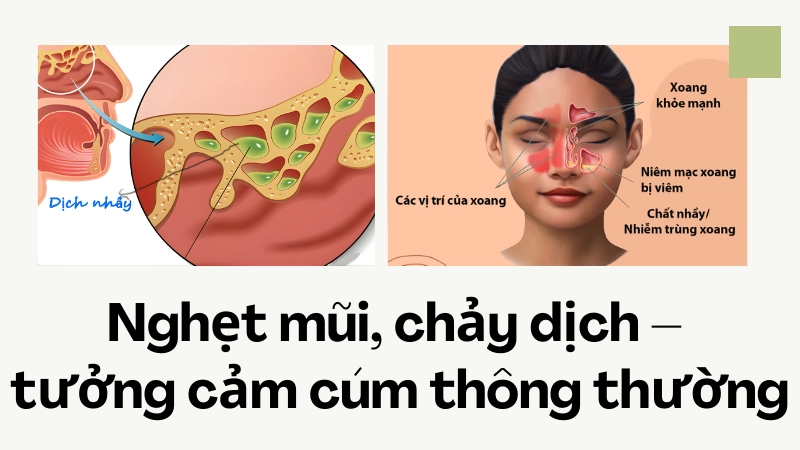 Nghẹt mũi, chảy dịch – tưởng cảm cúm thông thường