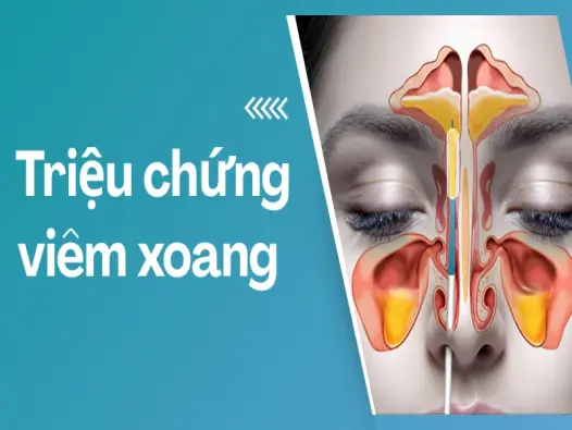 Giật mình trước loạt triệu chứng viêm xoang dễ bị bỏ qua