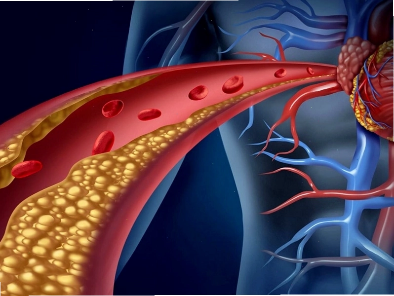 Lipid xấu quá nhiều gây tắc nghẽn mạch máu dẫn đến đột quỵ