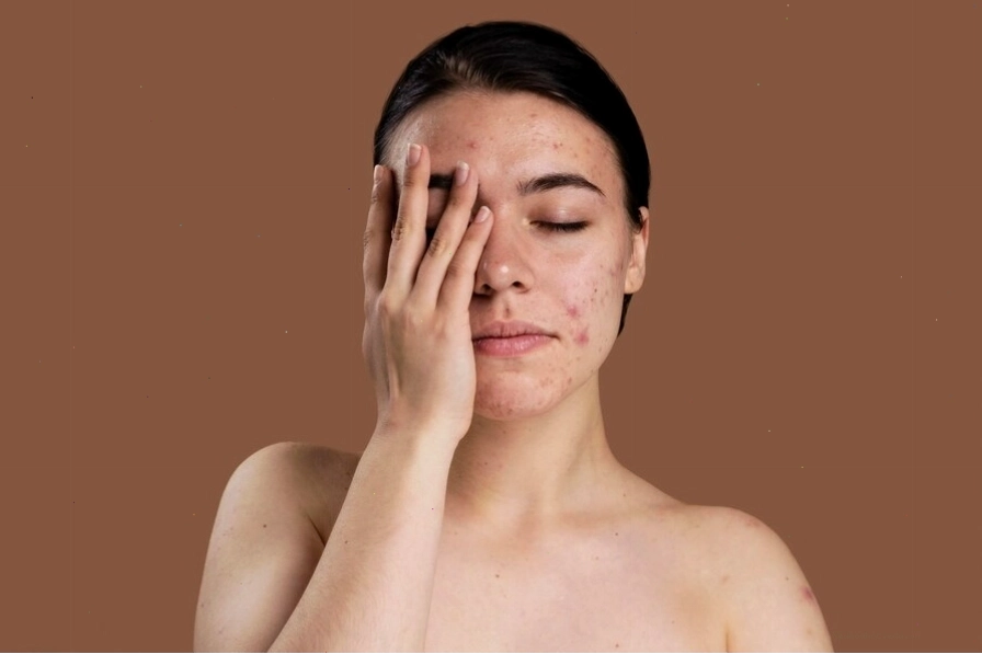 Mụn nội tiết tố ảnh hưởng đến làn da