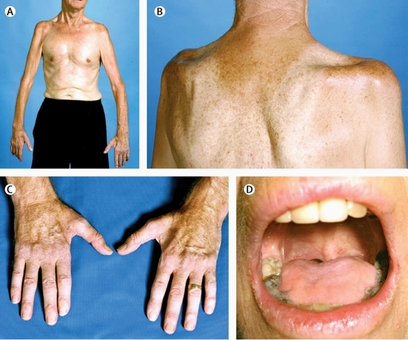 Người chăm sóc hỗ trợ bệnh nhân ALS trong sinh hoạt hàng ngày