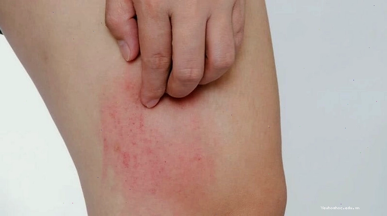 Người có cơ địa nhạy cảm có thể bị kích ứng da bởi Nacl