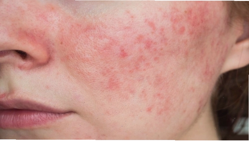 Tiếp xúc với phèn nồng độ cao có thể gây kích ứng da