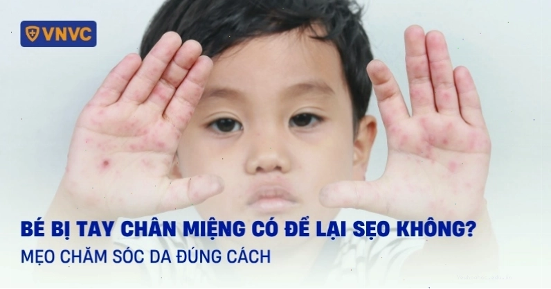 Trẻ bị Tay Chân Miệng có để lại sẹo không