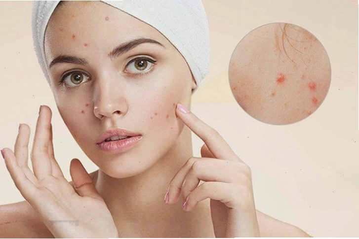 Ứng dụng của lưu huỳnh trong lĩnh vực làm đẹp