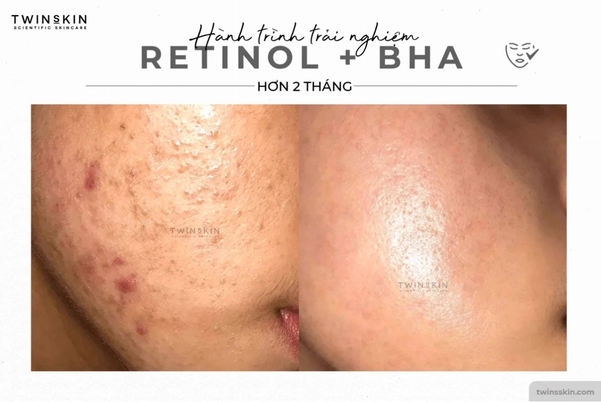 retinol bha twins skin