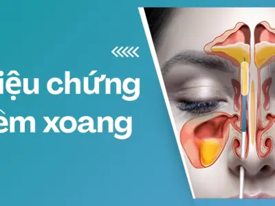 Giật mình trước loạt triệu chứng viêm xoang dễ bị bỏ qua